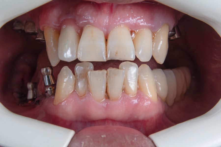 teeth falling out