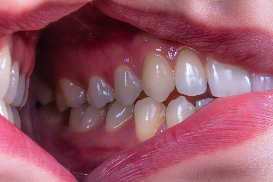 Photo teeth falling out